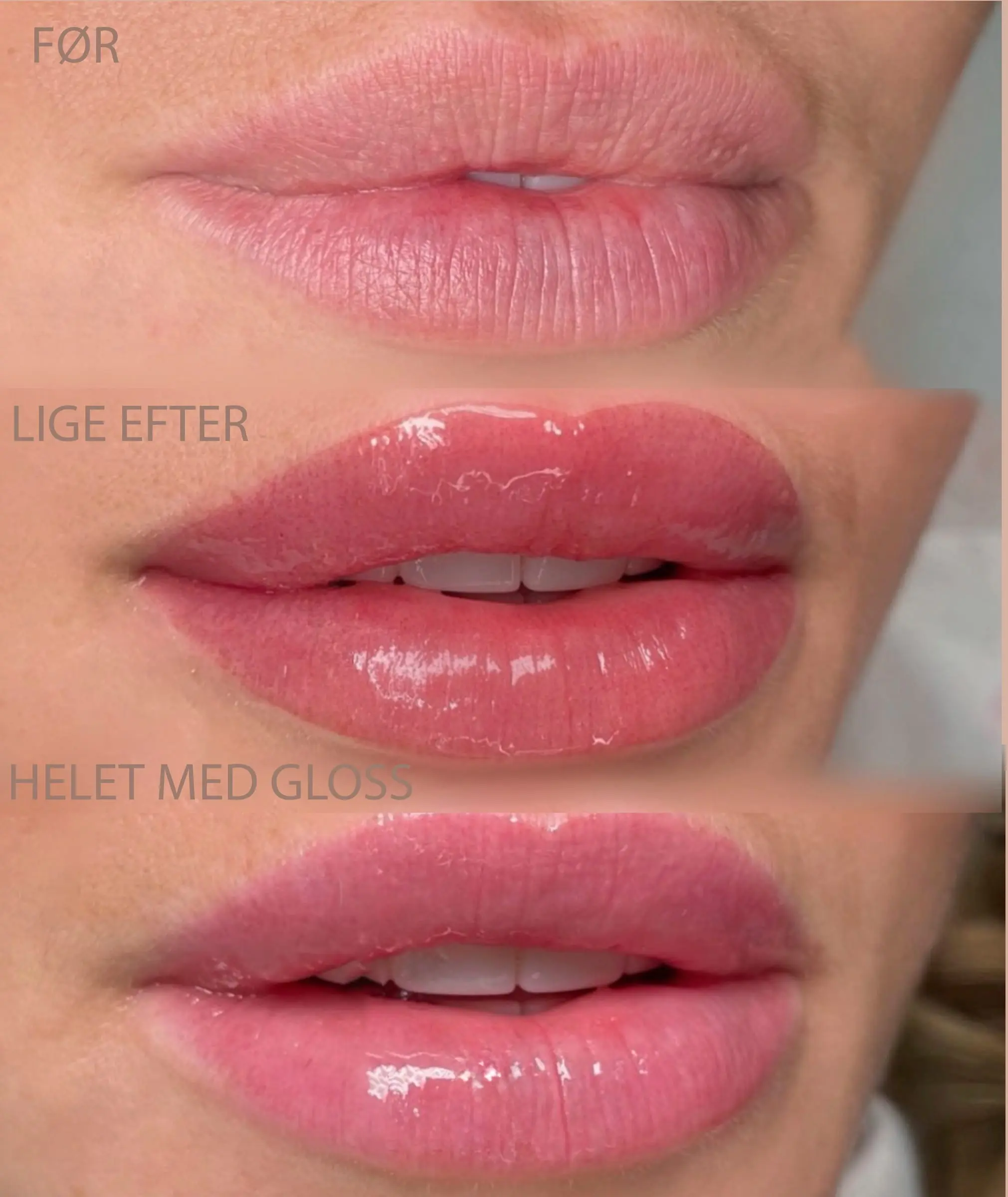 Læber — før, lige efter og healet. Læbepigmentering vist i tre trin: før behandling, lige efter, og det healede resultat med gloss.